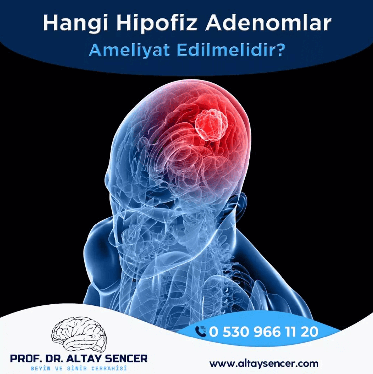 Hangi Hipofiz Adenomları Ameliyat Edilmelidir?