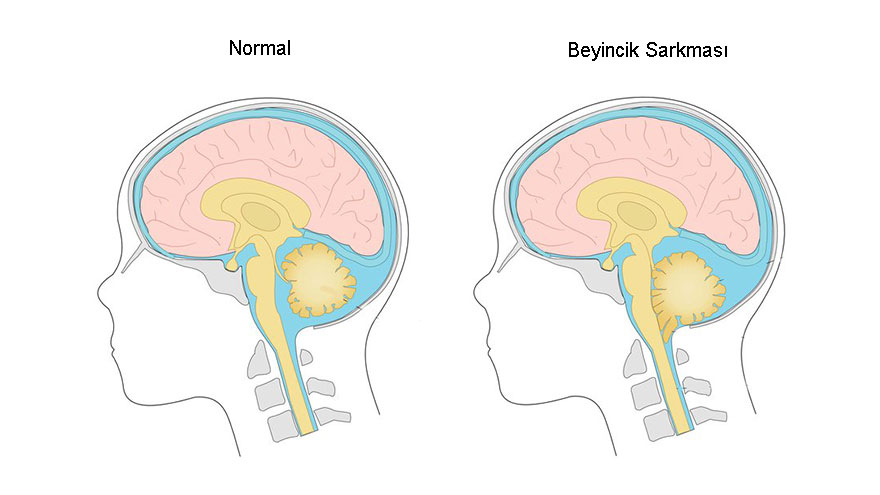 Beyincik Sarkması