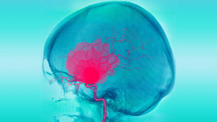 Beyin tümörlerinde Güncel Tedavi Yöntemleri
